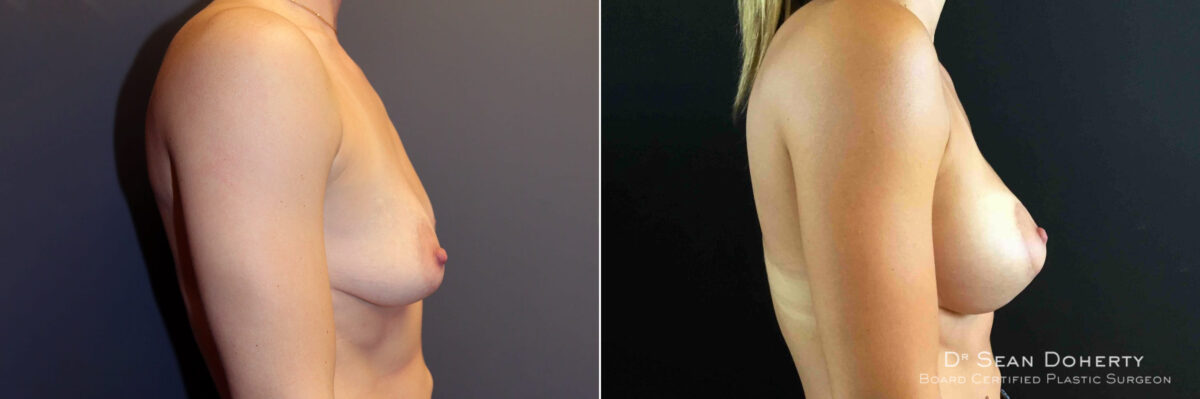 Breast Lift with Implants Before and After Photos in Boston, MA, Patient 5011