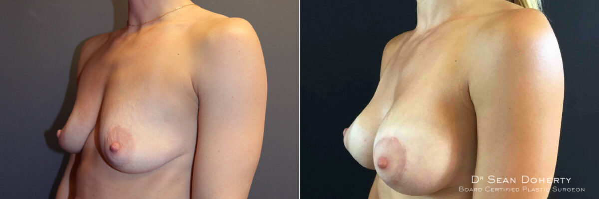 Breast Lift with Implants Before and After Photos in Boston, MA, Patient 5011