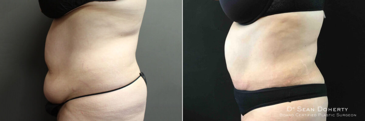 Liposuction Before and After Photos in Boston, MA, Patient 5057