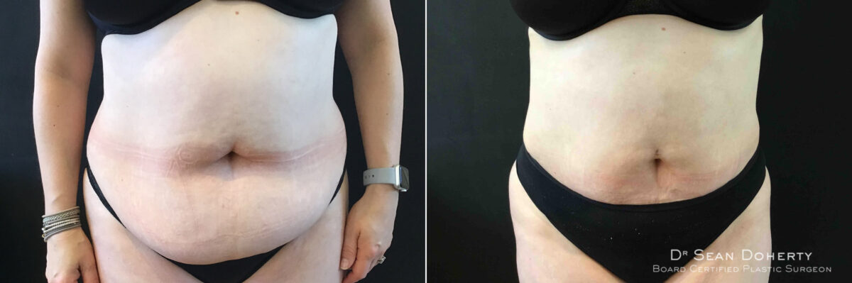 Liposuction Before and After Photos in Boston, MA, Patient 5057