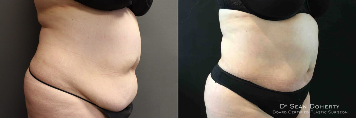 Liposuction Before and After Photos in Boston, MA, Patient 5057