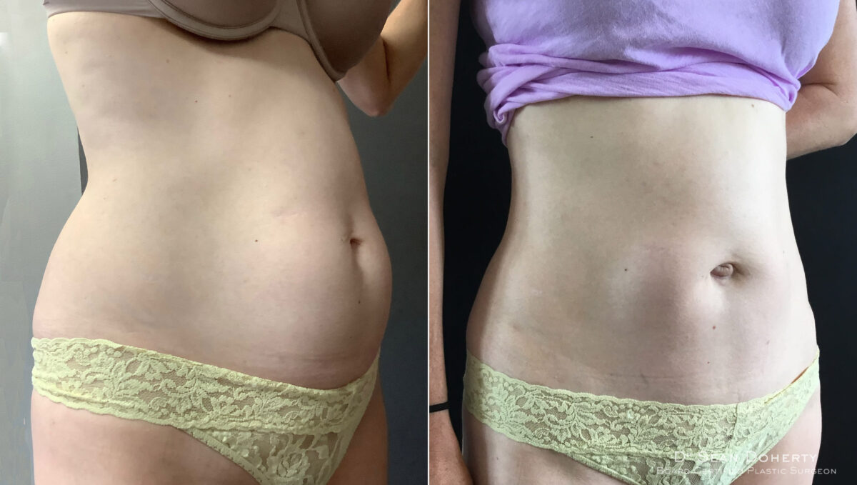 Tummy Tuck Before and After Photos in Boston, MA, Patient 5110