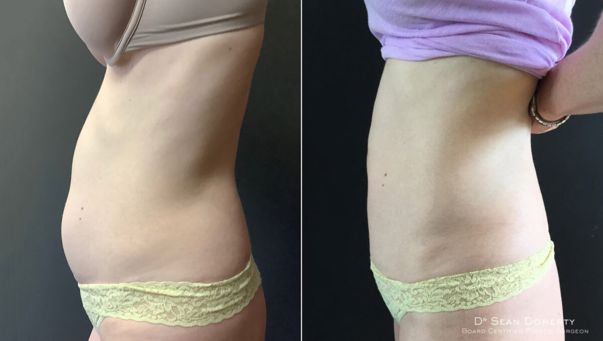 Tummy Tuck Before and After Photos in Boston, MA, Patient 5110