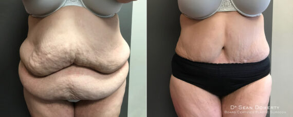 Tummy Tuck Before and After Photos in Boston, MA, Patient 5120
