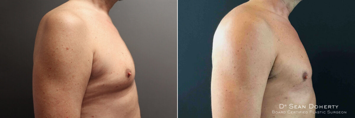 Gynecomastia Before and After Photos in Boston, MA, Patient 5204