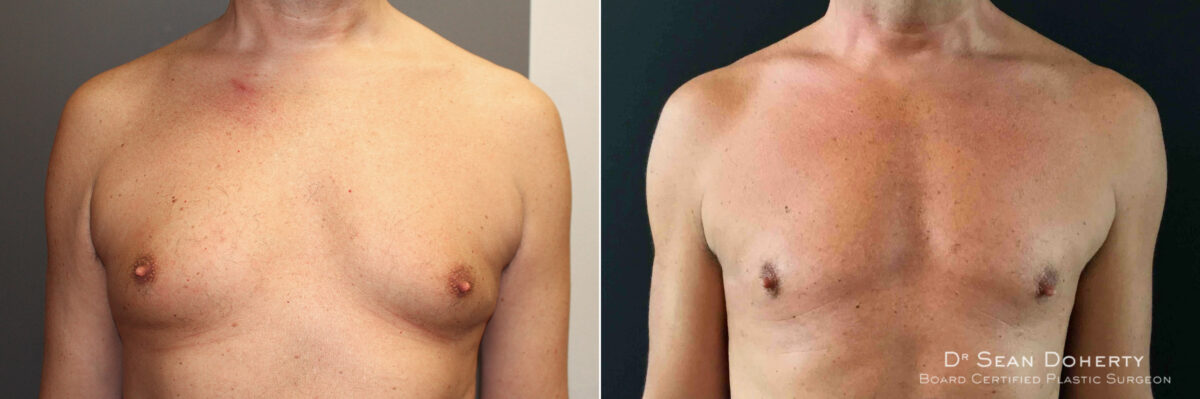 Gynecomastia Before and After Photos in Boston, MA, Patient 5204