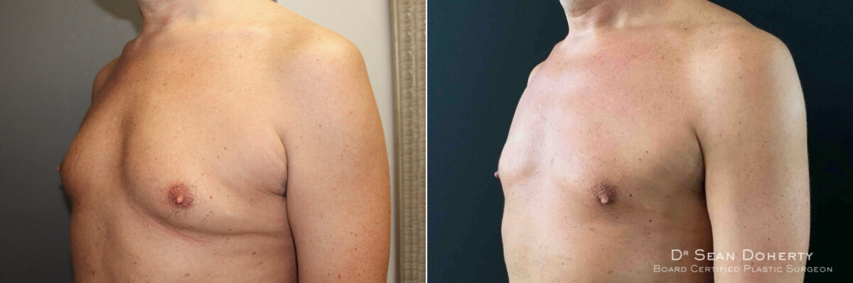 Gynecomastia Before and After Photos in Boston, MA, Patient 5204