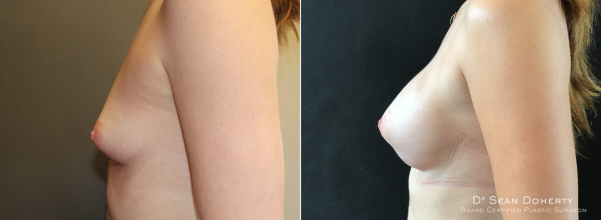 Breast Augmentation Before and After Photos in Boston, MA, Patient 5674