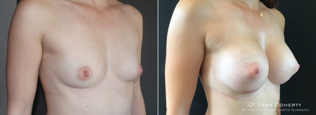 Breast Augmentation Before and After Photos in Boston, MA, Patient 5674