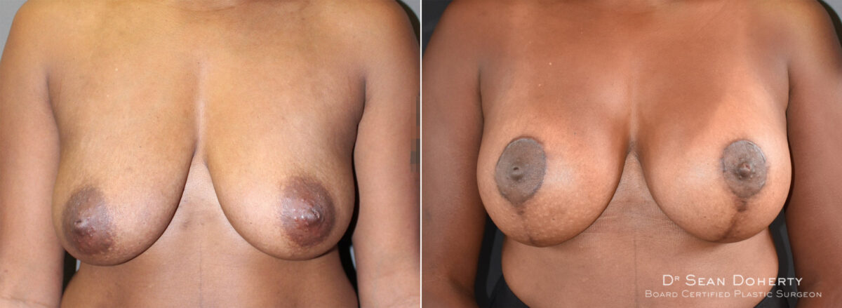 Breast Lift with Implants Before and After Photos in Boston, MA, Patient 5700