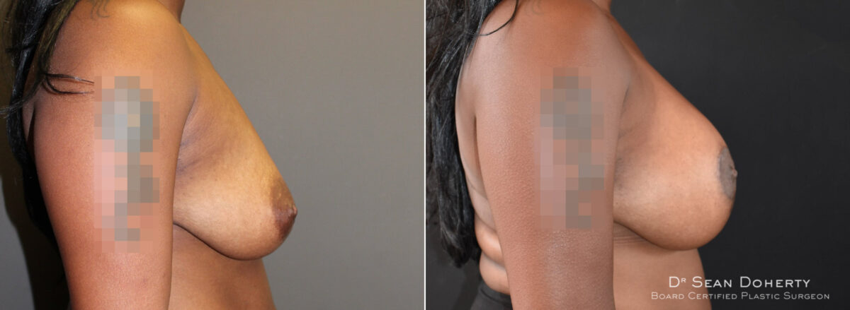 Breast Lift with Implants Before and After Photos in Boston, MA, Patient 5700