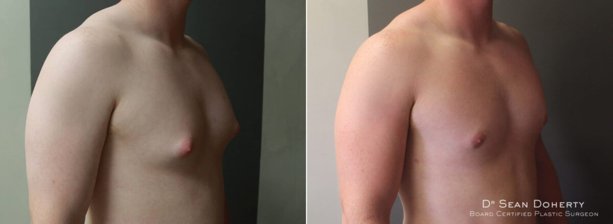 Gynecomastia Before and After Photos in Boston, MA, Patient 5720