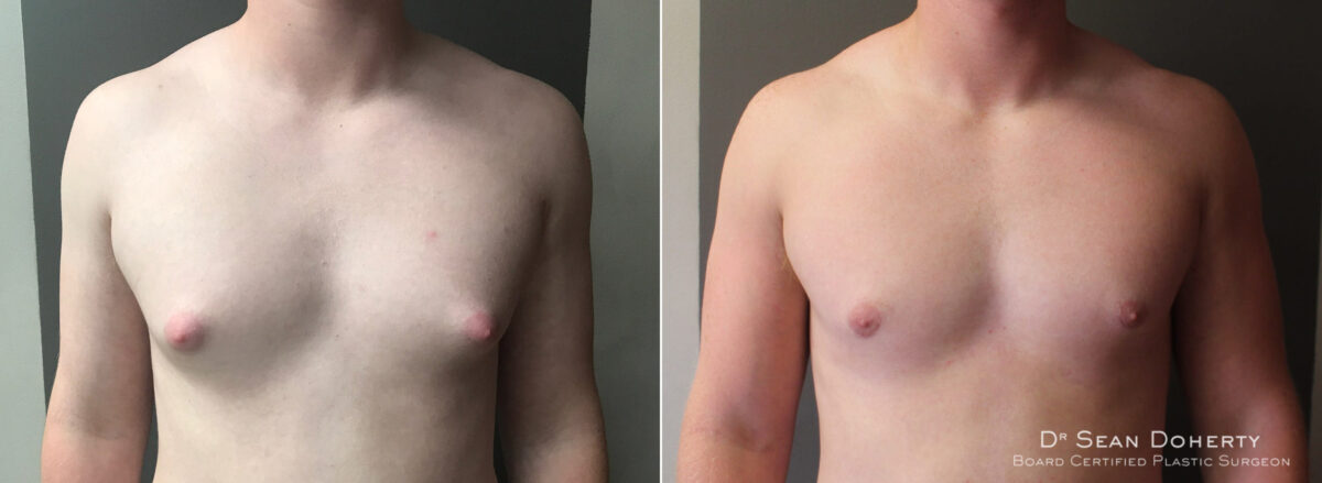Gynecomastia Before and After Photos in Boston, MA, Patient 5720