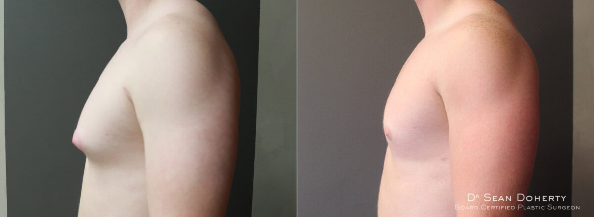 Gynecomastia Before and After Photos in Boston, MA, Patient 5720