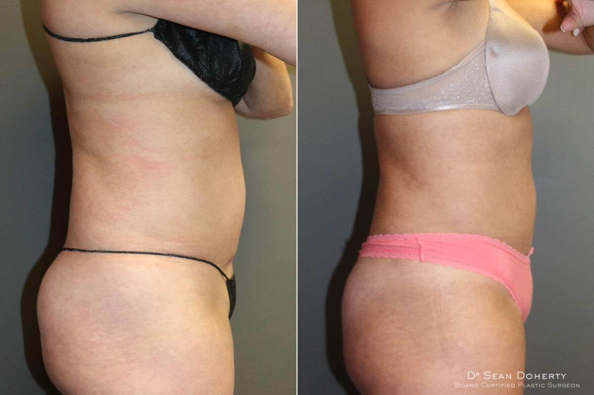 Liposuction Before and After Photos in Boston, MA, Patient 5750