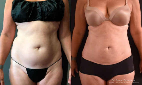Liposuction Before and After Photos in Boston, MA