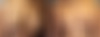 Breast Lift Before and After Photos in Boston, MA, Patient 5770