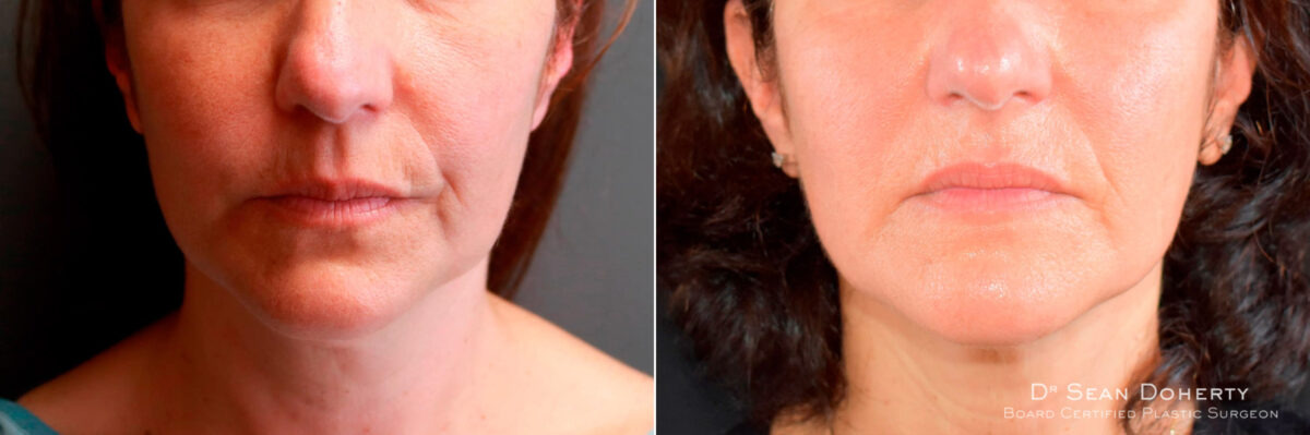 Liposuction Before and After Photos in Boston, MA, Patient 5820