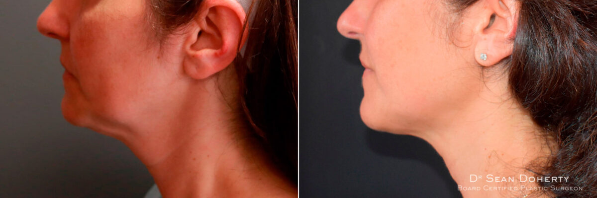 Liposuction Before and After Photos in Boston, MA, Patient 5820