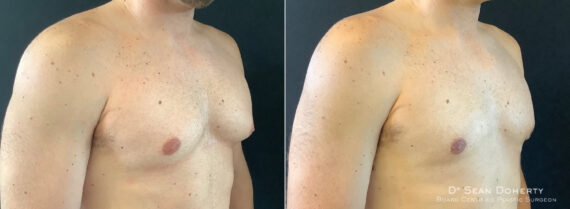 Gynecomastia Before and After Photos in Boston, MA, Patient 5830