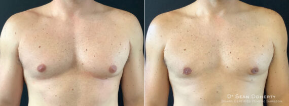 Gynecomastia Before and After Photos in Boston, MA, Patient 5830
