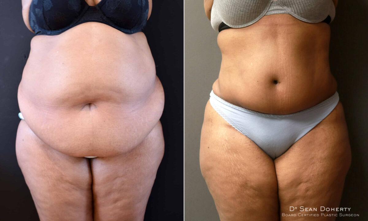 Tummy Tuck Before and After Photos in Boston, MA, Patient 6553