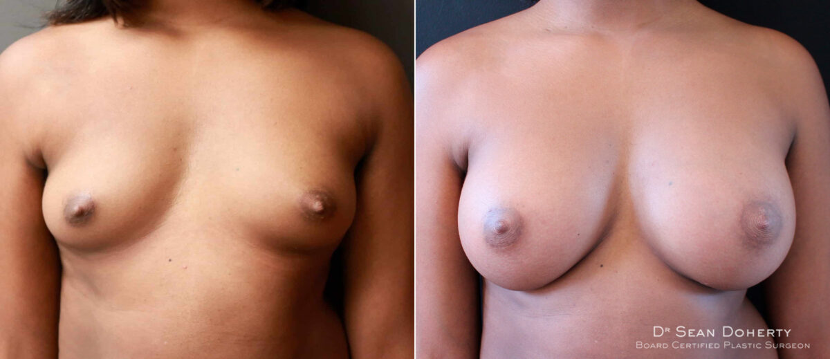 Breast Augmentation Before and After Photos in Boston, MA, Patient 6563