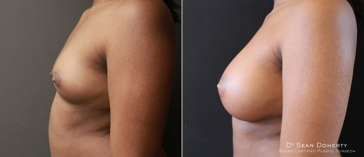 Breast Augmentation Before and After Photos in Boston, MA, Patient 6563