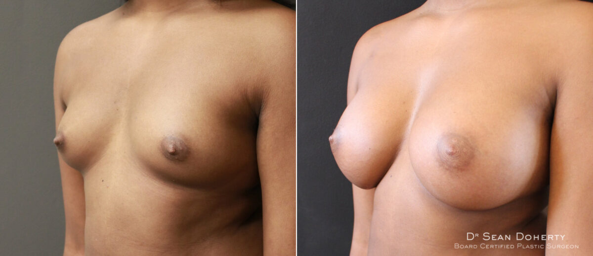 Breast Augmentation Before and After Photos in Boston, MA, Patient 6563