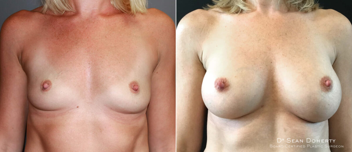Breast Augmentation Before and After Photos in Boston, MA, Patient 6567