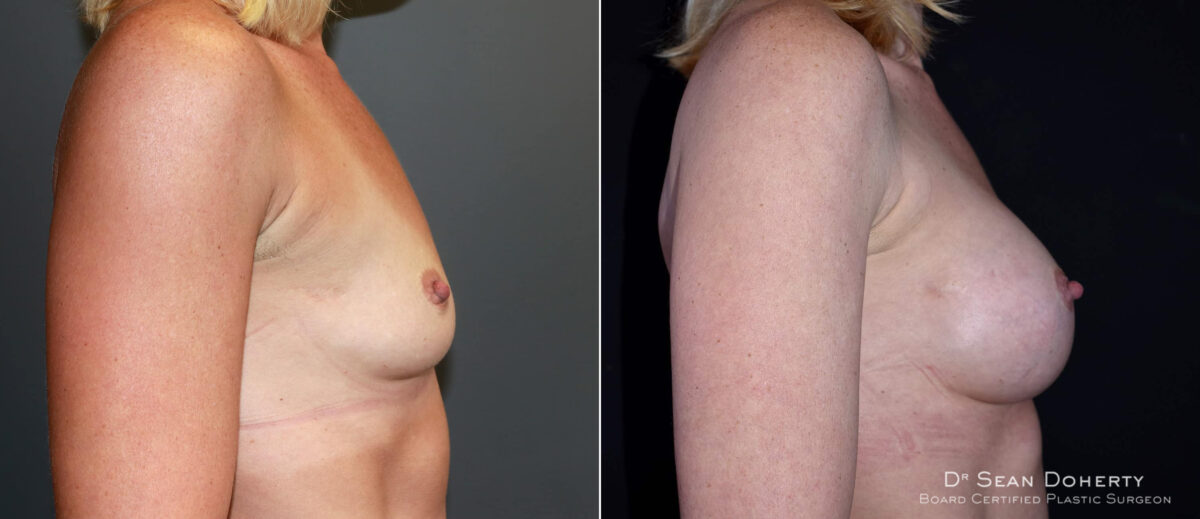Breast Augmentation Before and After Photos in Boston, MA, Patient 6567