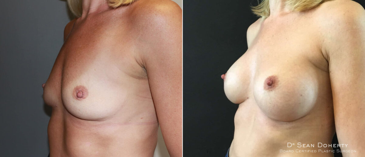 Breast Augmentation Before and After Photos in Boston, MA, Patient 6567