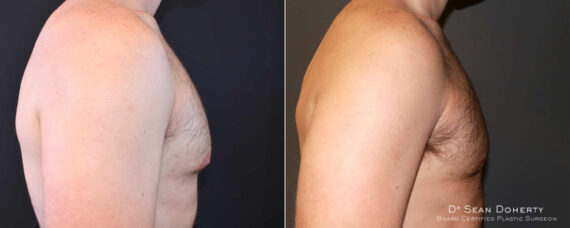 Gynecomastia Before and After Photos in Boston, MA, Patient 6612