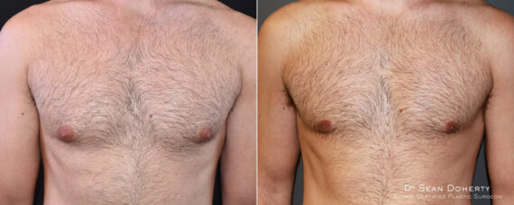 Gynecomastia Before and After Photos in Boston, MA, Patient 6612