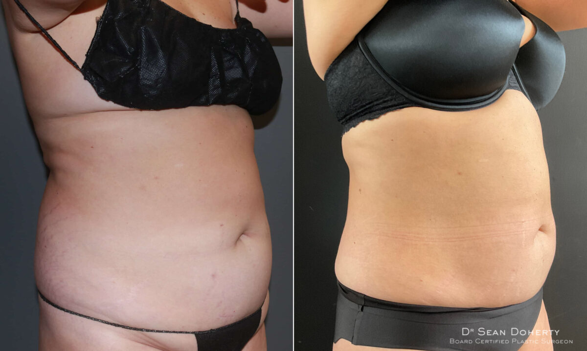 Liposuction Before and After Photos in Boston, MA, Patient 6701
