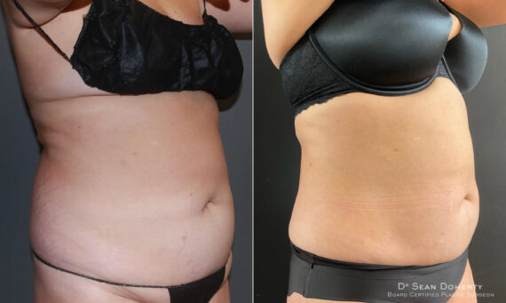 Liposuction Before and After Photos in Boston, MA, Patient 6701