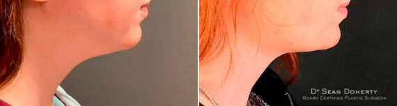 Liposuction Before and After Photos in Boston, MA, Patient 6702