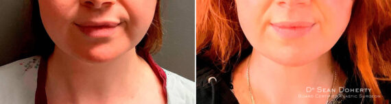 Liposuction Before and After Photos in Boston, MA, Patient 6702