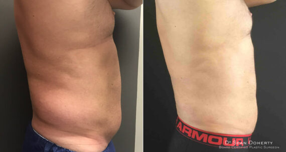 Liposuction Before and After Photos in Boston, MA, Patient 6721