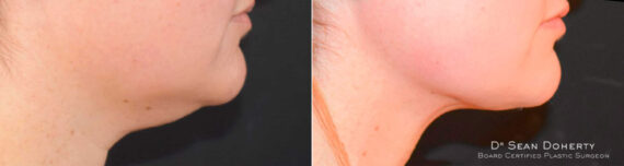 Liposuction Before and After Photos in Boston, MA, Patient 6722