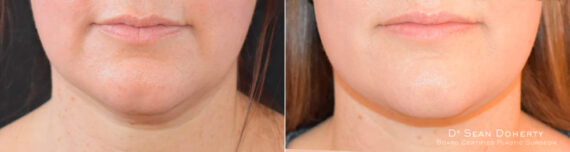Liposuction Before and After Photos in Boston, MA, Patient 6722