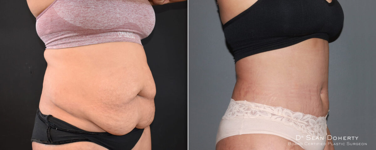 Tummy Tuck Before and After Photos in Boston, MA, Patient 6723