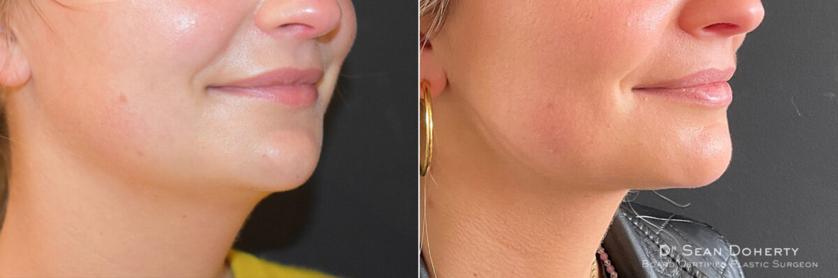 Liposuction Before and After Photos in Boston, MA, Patient 7575