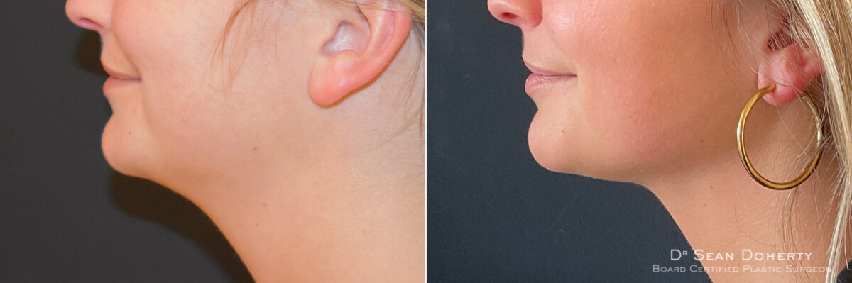 Liposuction Before and After Photos in Boston, MA, Patient 7575