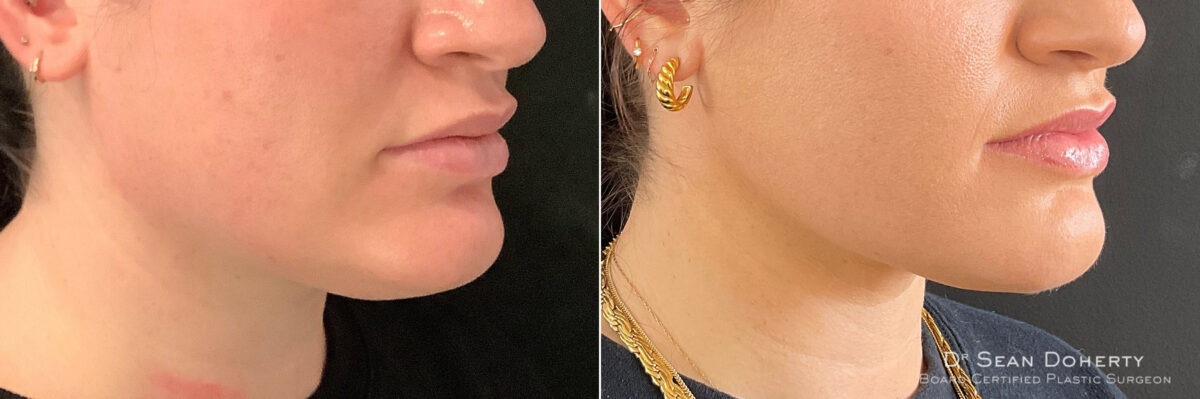 Liposuction Before and After Photos in Boston, MA, Patient 7585
