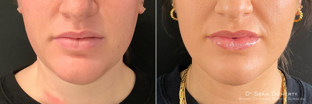 Liposuction Before and After Photos in Boston, MA, Patient 7585
