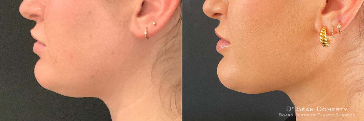 Liposuction Before and After Photos in Boston, MA, Patient 7585