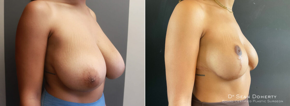 Breast Reduction Before and After Photos in Boston, MA, Patient 7756
