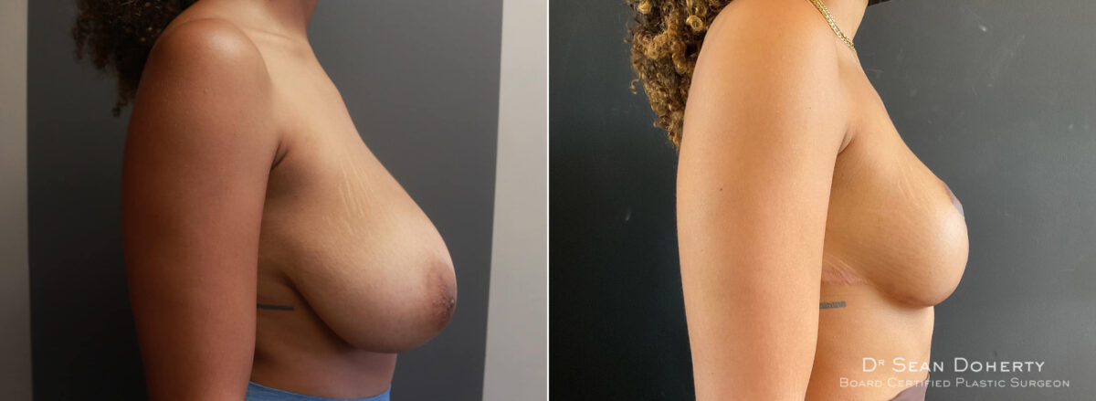 Breast Reduction Before and After Photos in Boston, MA, Patient 7756