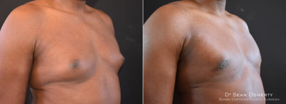 Gynecomastia Before and After Photos in Boston, MA, Patient 7758